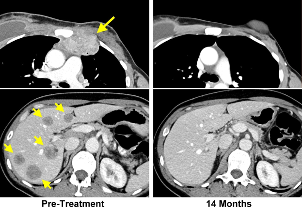 Eine CT-Aufnahme der Brust eines Patienten mit einem gelben Pfeil, der nach links zeigt, und einem schwarz-weißen Hirnbild mit der Beschriftung "vor der Behandlung" und "14 Monate" unten.